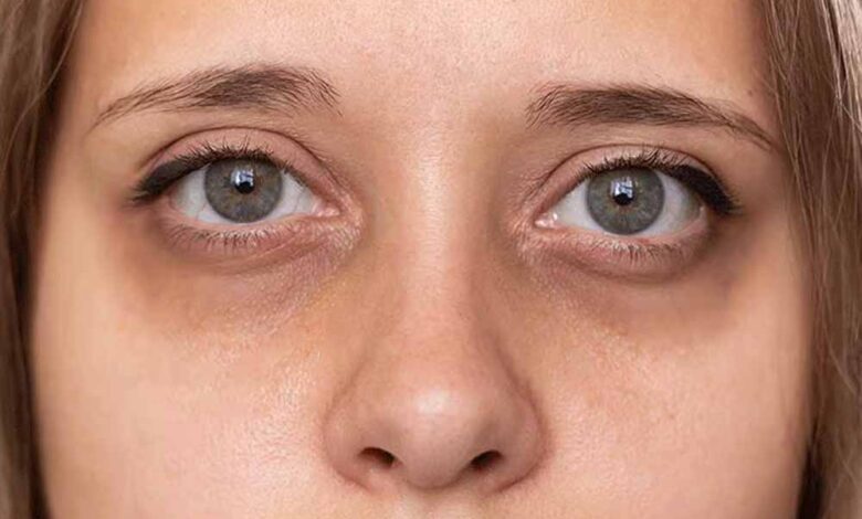 स्ट्रेस, खराब डाइट और नींद की कमी के कारण होते है डार्क सर्कल्स, ऐसे करें दूर