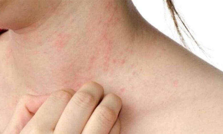 गर्मियों में स्‍कि‍न रेडनेस की समस्‍या आम है, ट्राई करें ये ट‍िप्‍स