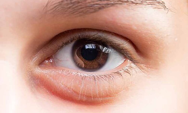 कैसे कम करें आंखों की सूजन – Khabar Jagat