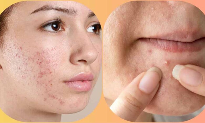 मुहांसे हटाने का ये उपाय पड़ सकता है भारी, चेहरे को पहुंचा सकता है नुकसान