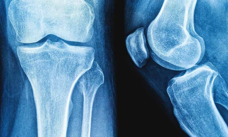 हड्डियों की मरम्मत के लिए प्रोटीन से नए उपचार के रास्ते – Khabar Jagat