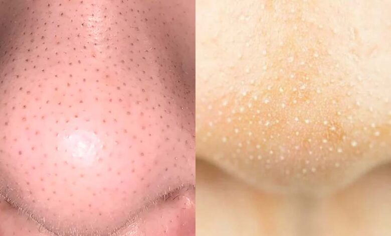 क्या है फर्क और कैसे करें इलाज? – Khabar Jagat