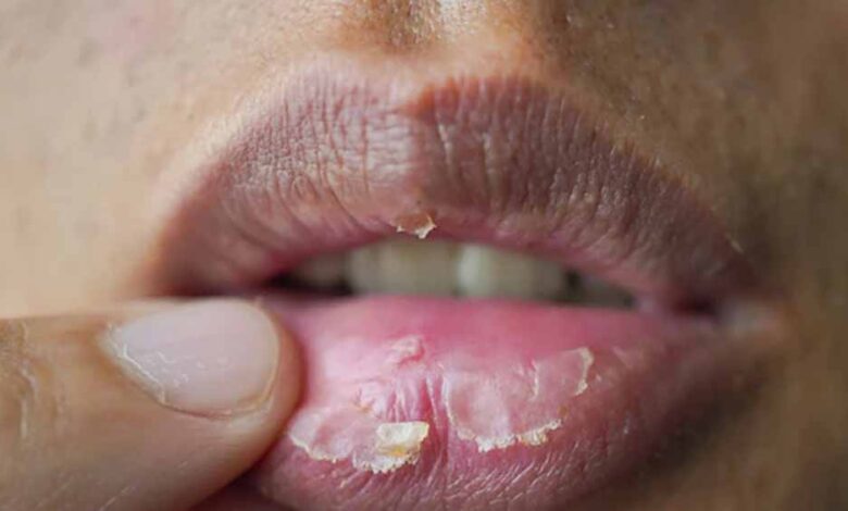 रूखे होंठों की समस्या? किचन की ये चीजें वापस लाएंगी निखार