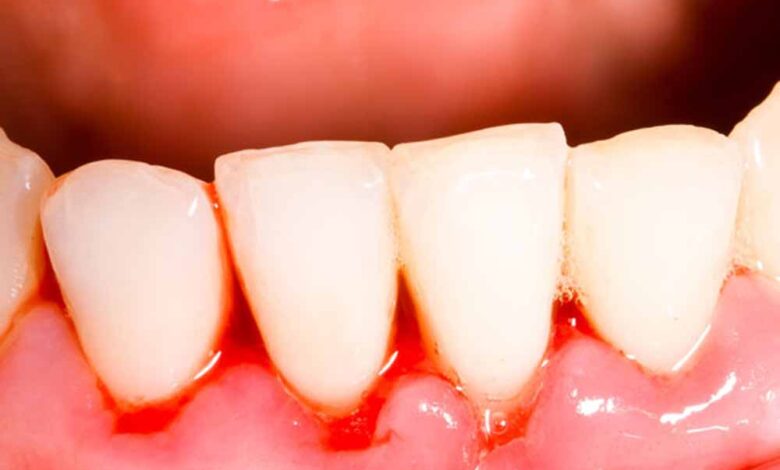 ब्रश करते समय मसूड़ों से खून आ रहा है? जानें कारण और आसान घरेलू उपाय