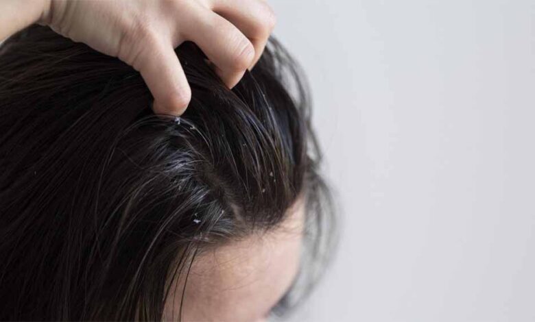 ड्राय स्कैल्प के लिए अपनाएं ये 3 घरेलू उपाय – Khabar Jagat