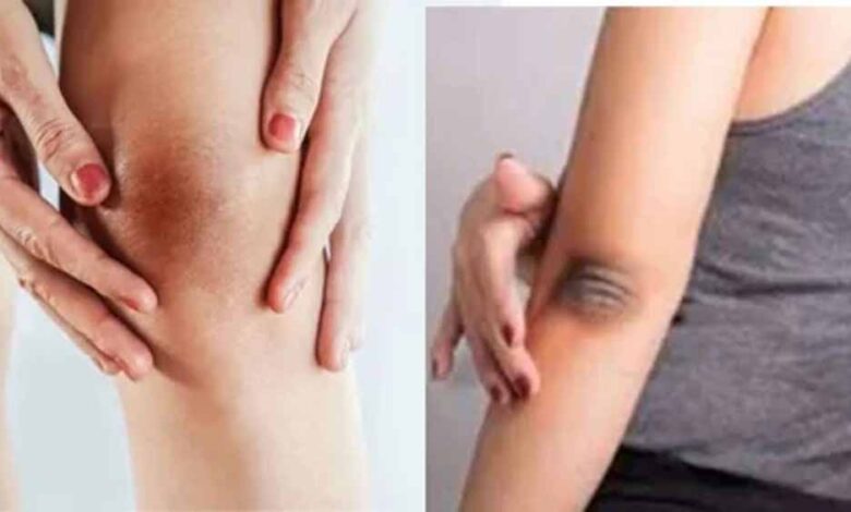 ऐसे दूर करें कोहनी और घुटनों के कालेपन को – Khabar Jagat