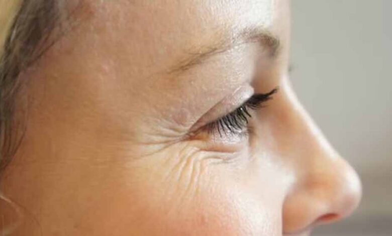 आँखों के नीचे झुर्रिया को दूर करने के घरेलू नुस्खों