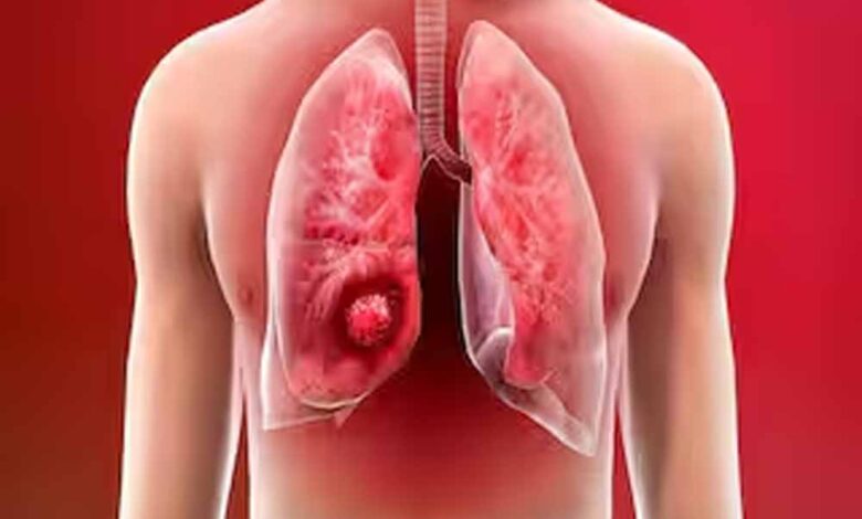फेफड़ों के कैंसर पर वैज्ञानिकों की बड़ी जीत! नया शोध ट्यूमर को 80% तक सिकोड़ने में सफल