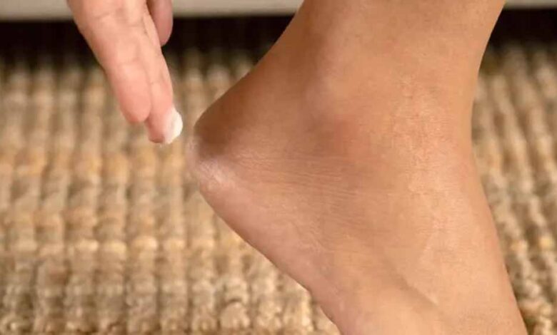 सर्द के मौसम में एड़ियों की करें सही देखभाल! – Khabar Jagat