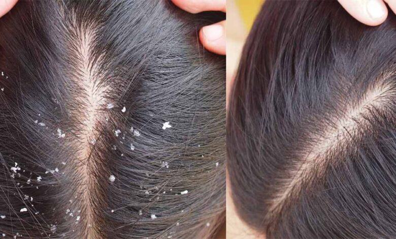 डैंड्रफ नहीं, स्कैल्प की गंभीर समस्या भी हो सकती है! तेल लगाने से पहले जान लें ये सच्चाई
